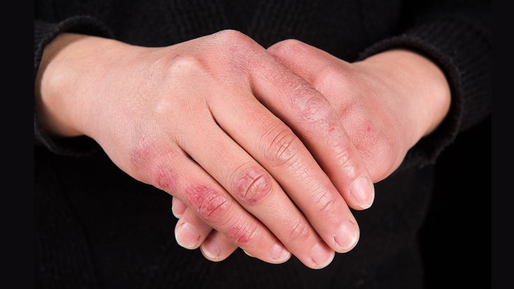 Why Do Hands Get Drier in Fall